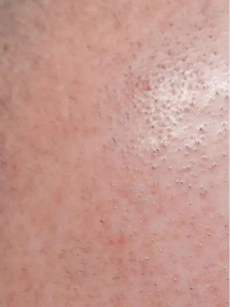Pigmentation treatment  in action after results