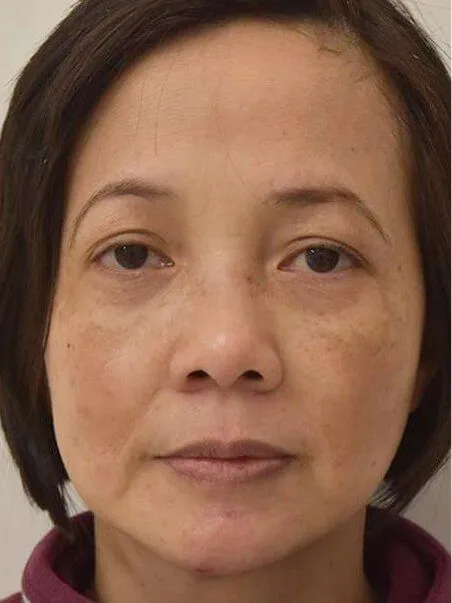 Pigmentation treatment  in action before results