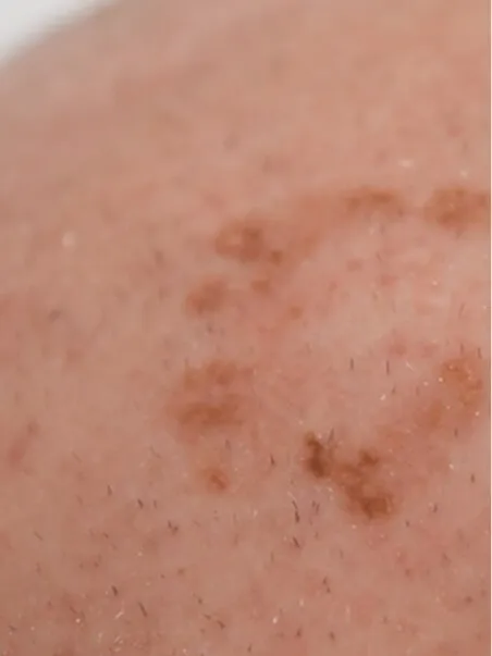 Pigmentation treatment  in action before results