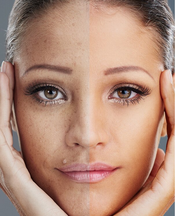 Pigmentation