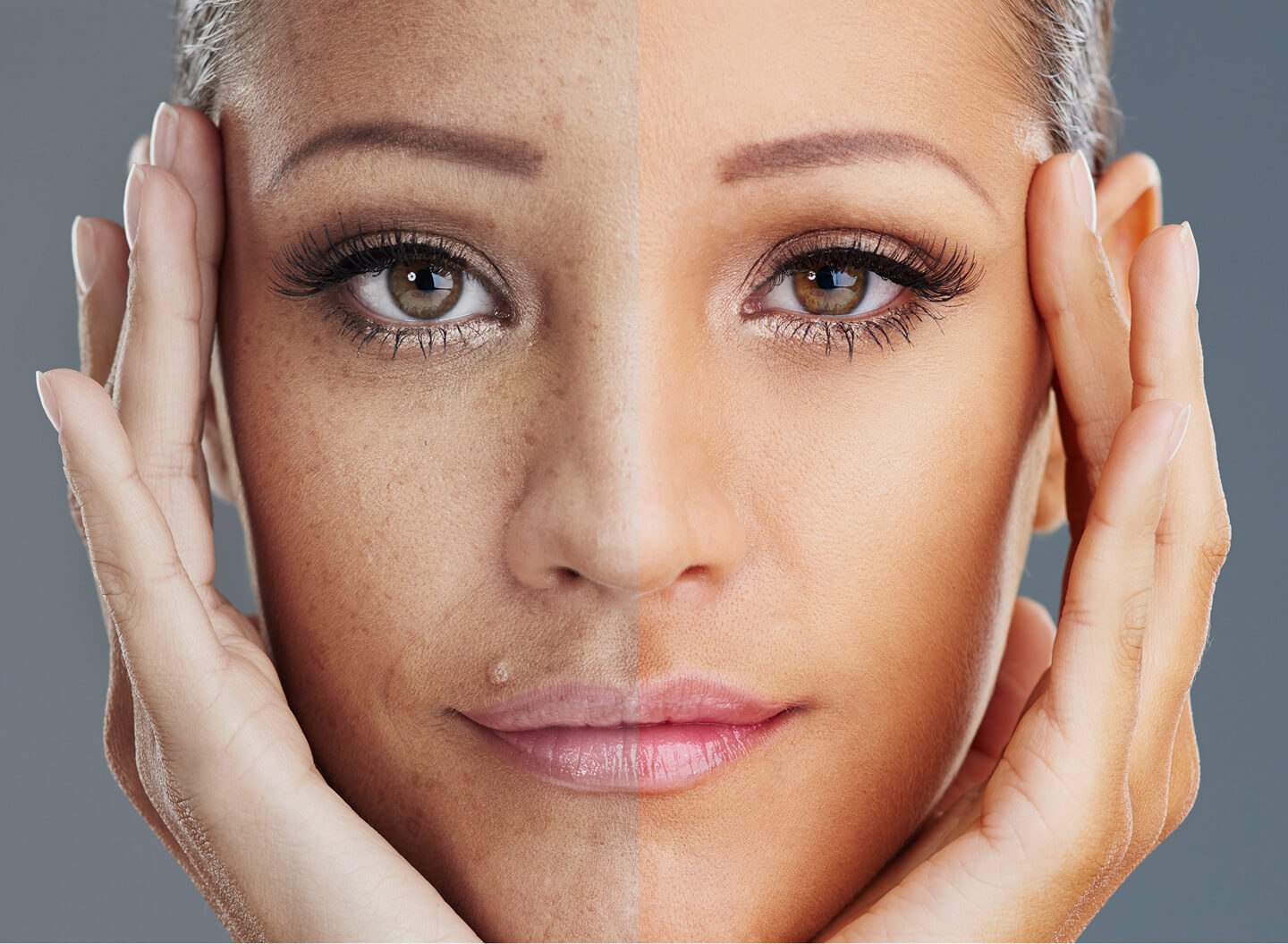 Pigmentation