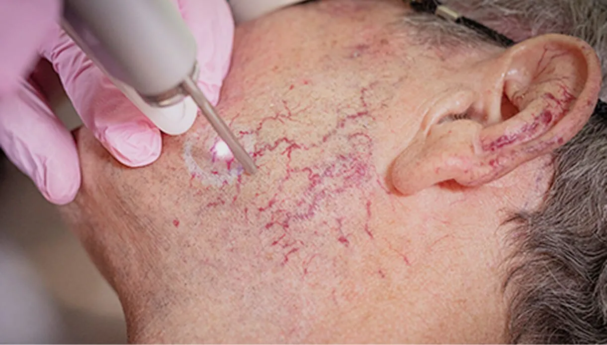 Preparing for Thread Vein Removal