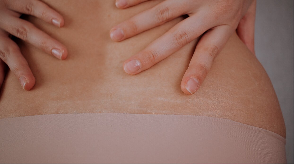 Say Goodbye to Stretch Marks Say Goodbye to Stretch Marks
