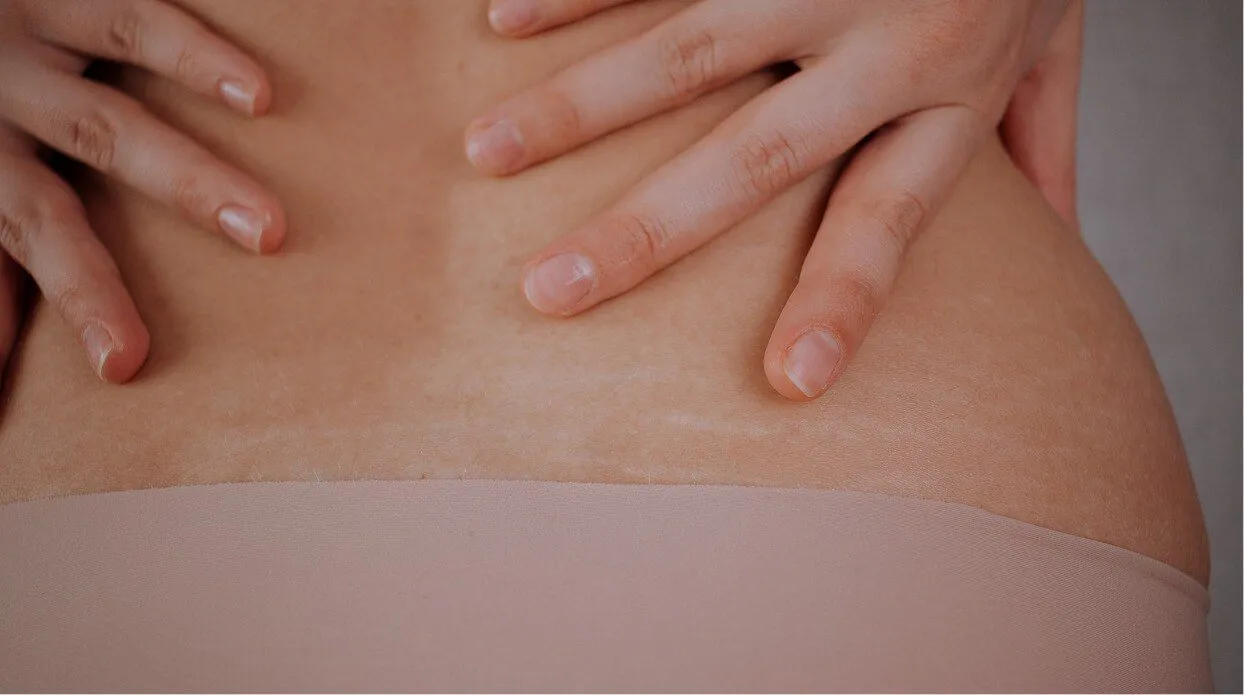 Say Goodbye to Stretch Marks