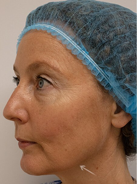 Thread Lift treatment in action
 after result