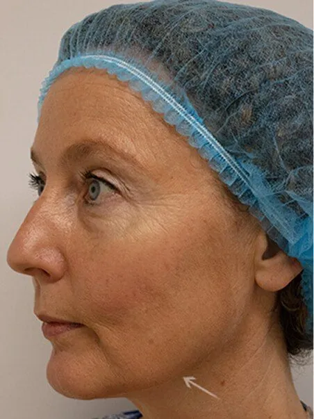 Thread Lift treatment in action
 after result