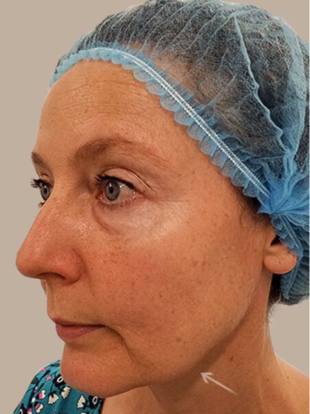 Thread Lift treatment in action
 before result