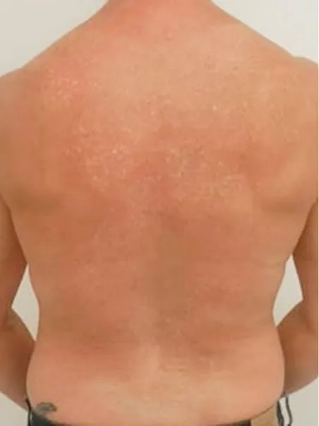 treatment  in action Tattoo Removal after results