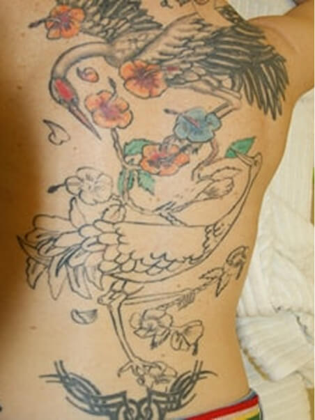 treatment  in action Tattoo Removal before results