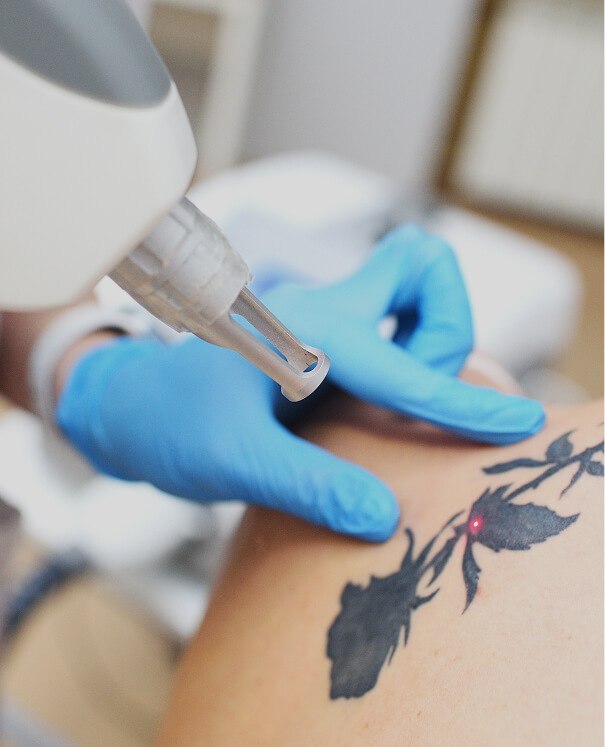Tattoo Removal