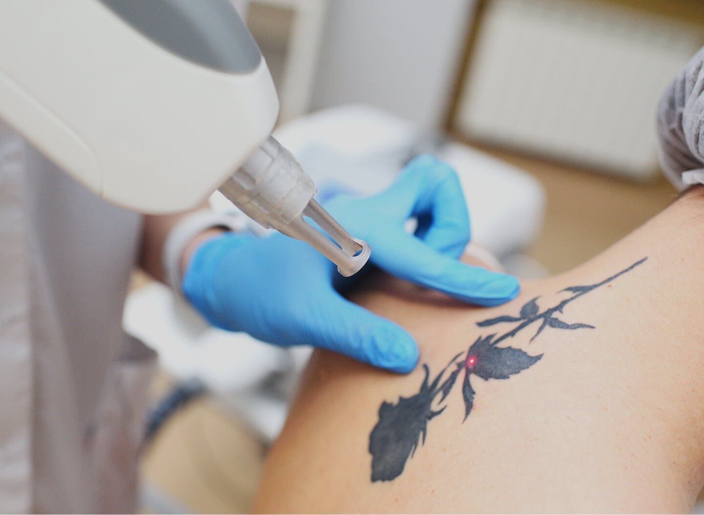 Tattoo Removal
