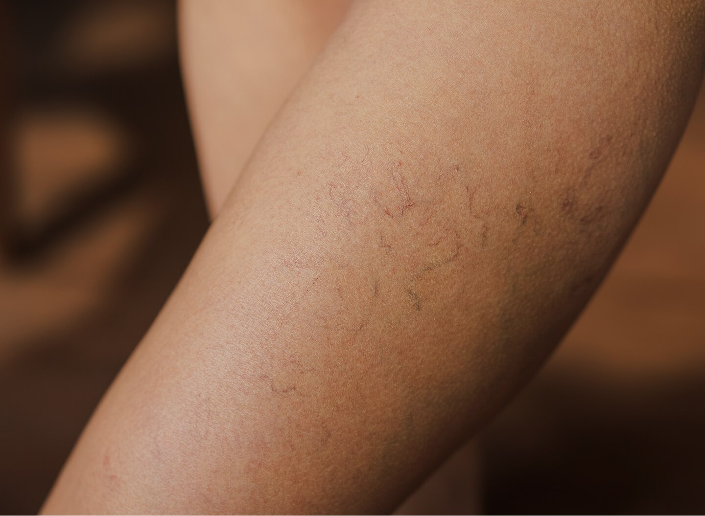 Thread Vein