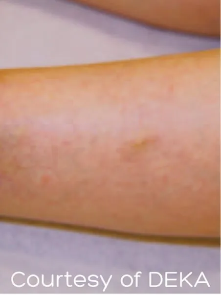 Thread Vein treatment  in action after results