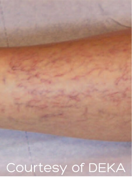 Thread Vein treatment  in action before results