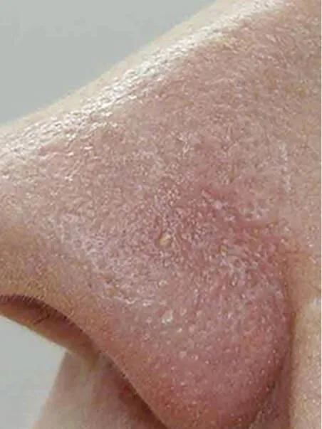 Thread Vein treatment  in action after results