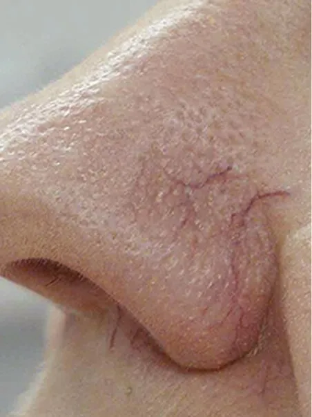 Thread Vein treatment  in action before results