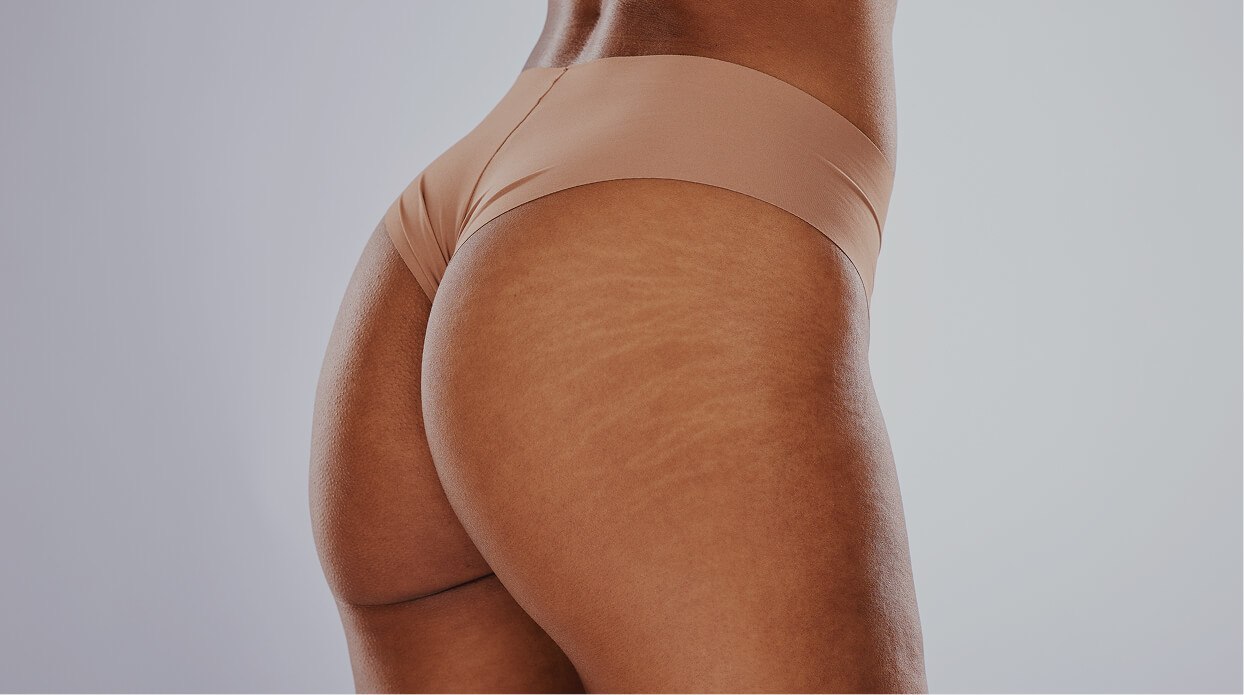 Why Choose rtwskin for Stretch Mark Removal Treatments_ Why Choose rtwskin for Stretch Mark Removal with laser?