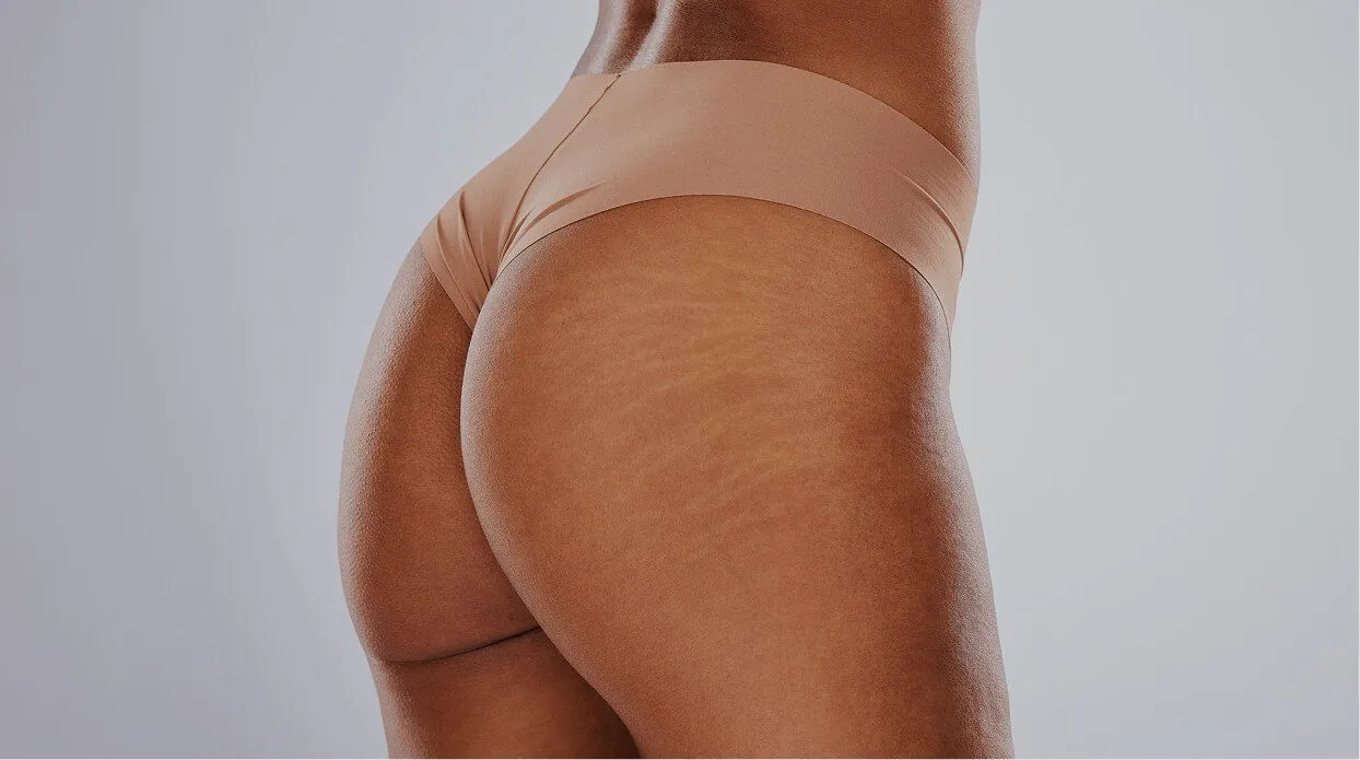 Why Choose rtwskin for Stretch Mark Removal with laser?