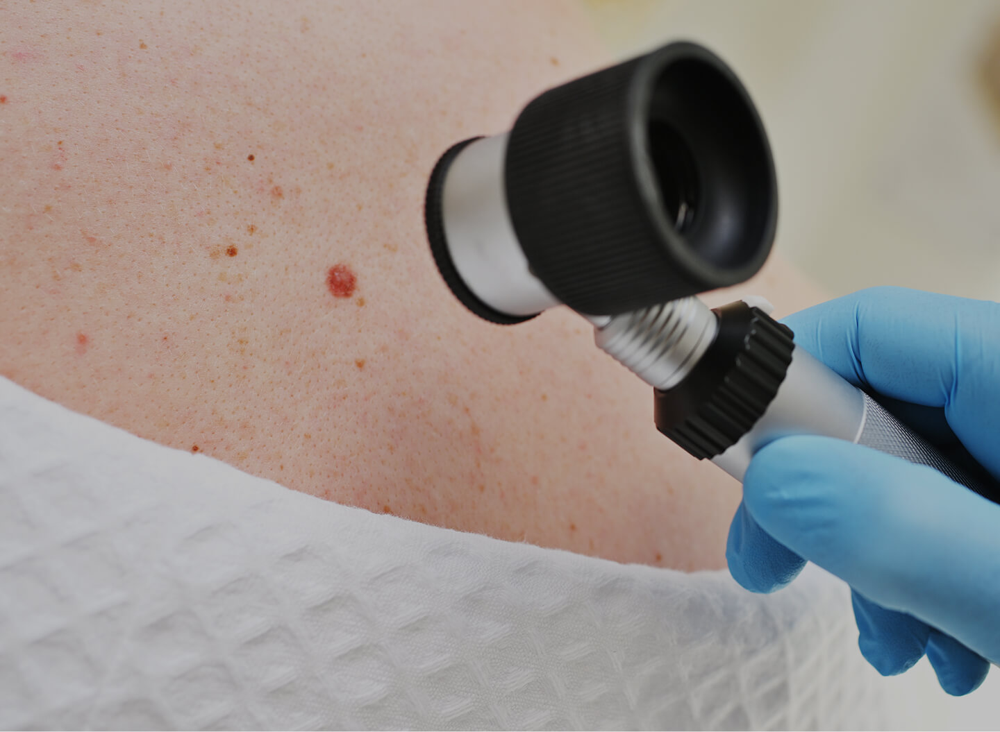 Benign Skin Lesions