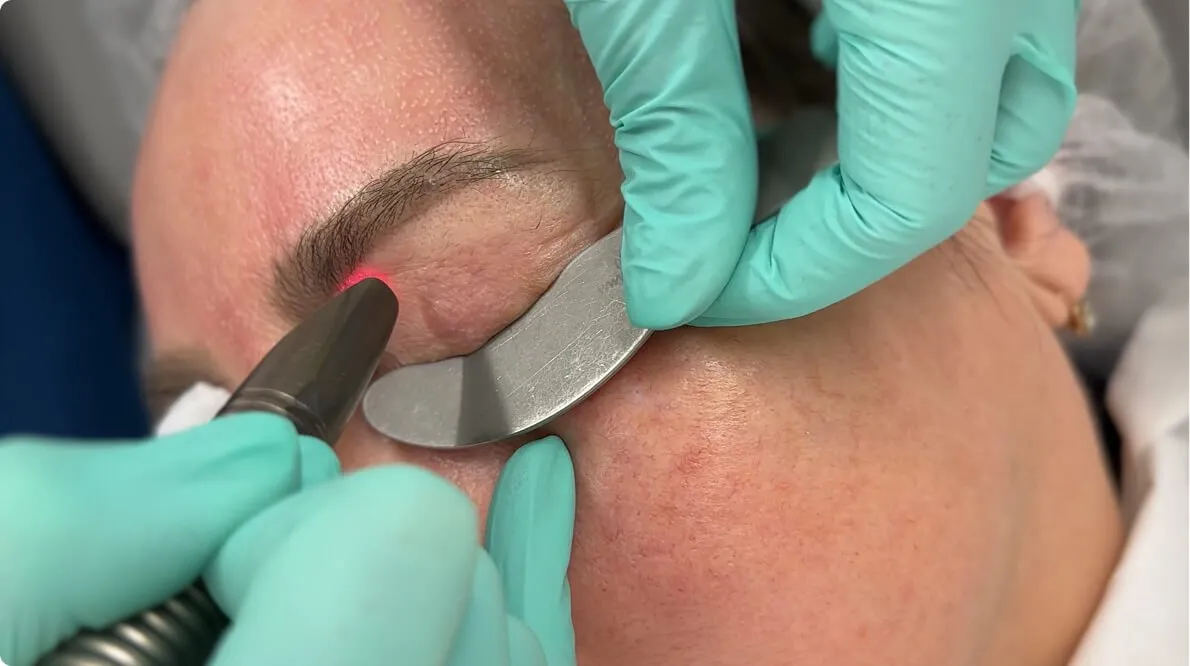 Advanced Non-Surgical Rejuvenation: My Experience with Laser