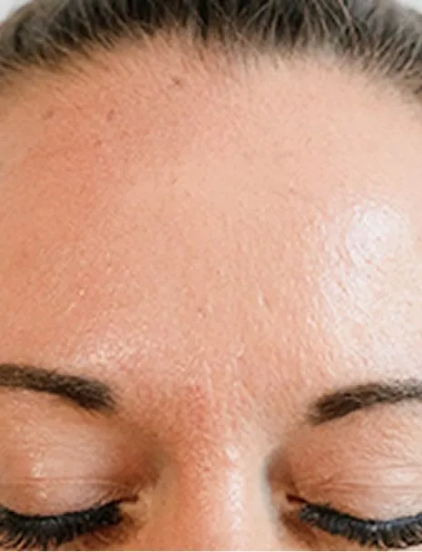 botox after