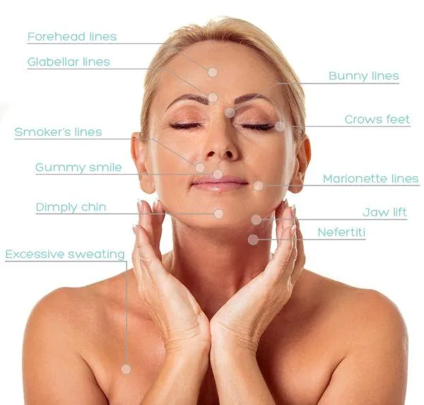 botox-areas