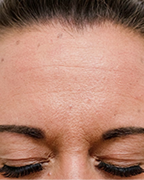 botox before
