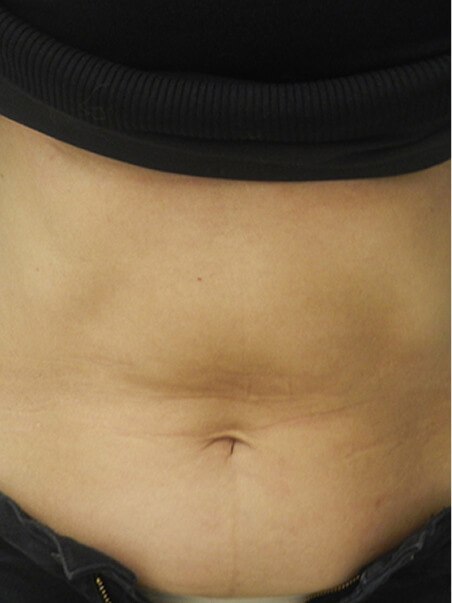 Cold Body Sculpting treatment in action after results