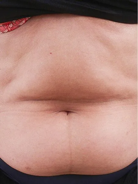 Cold Body Sculpting treatment in action
 before result