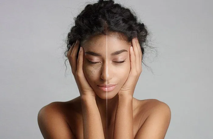 Dermatosis Papulosa Nigra: The unfamiliar skin condition that you may be experiencing