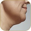 Double chin
