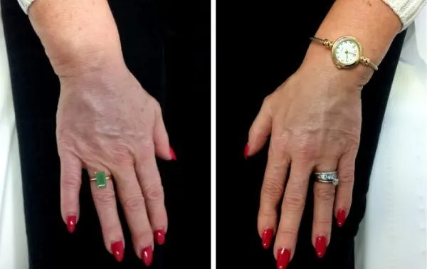 Hand Rejuvenation: The Secret to Youthful Hands content post image