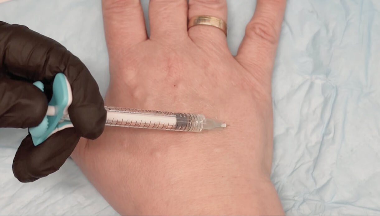 Hand Rejuvenation Cost_ What to Expect Hand Rejuvenation Cost: What to Expect