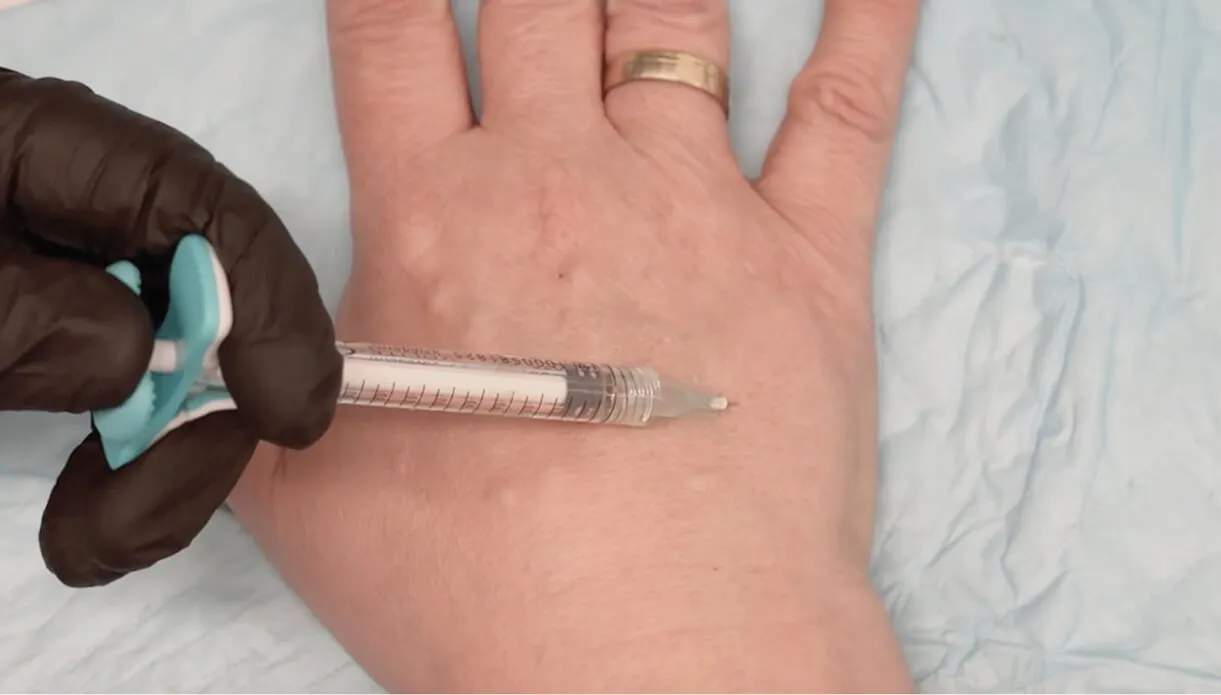 Hand Rejuvenation Cost: What to Expect