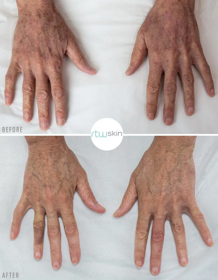 Skin Deep: Everything you need to know about Pigmentation content post image