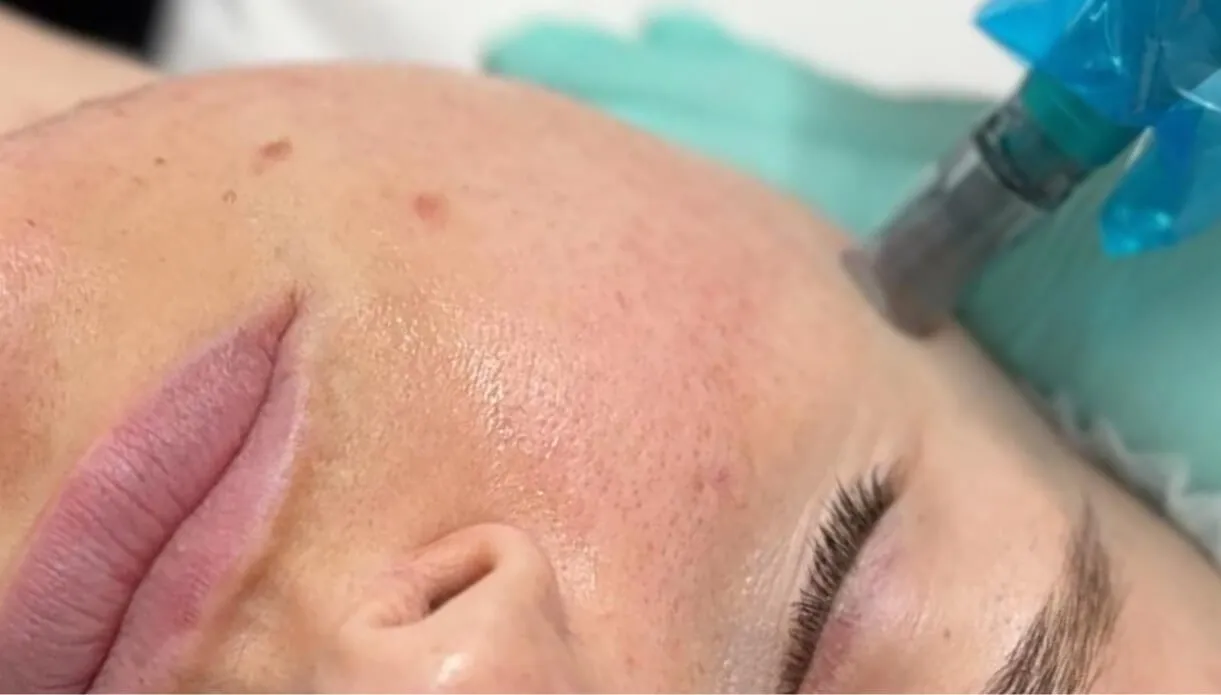 Why choose microneedling at rtwskin?