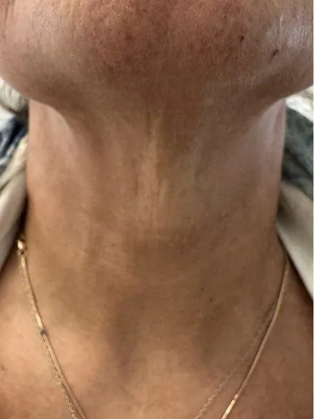 Lanluma treatment  in action after results