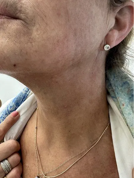 Lanluma treatment  in action after results