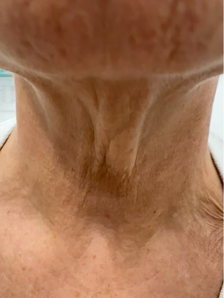 Lanluma treatment  in action before results