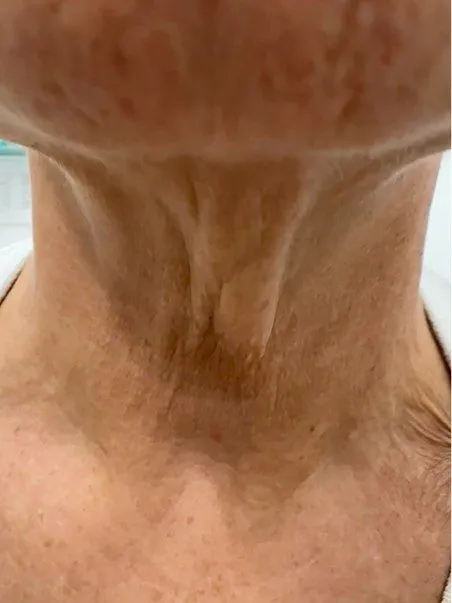 Lanluma treatment  in action before results