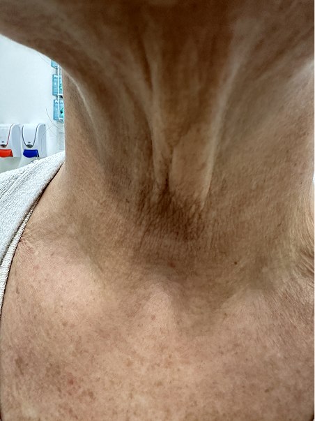 Lanluma treatment  in action before results