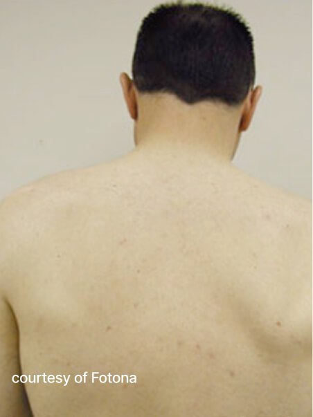 Laser Hair Removal in action  after results