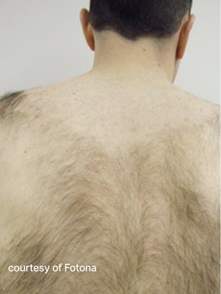 Laser Hair Removal in action  before results