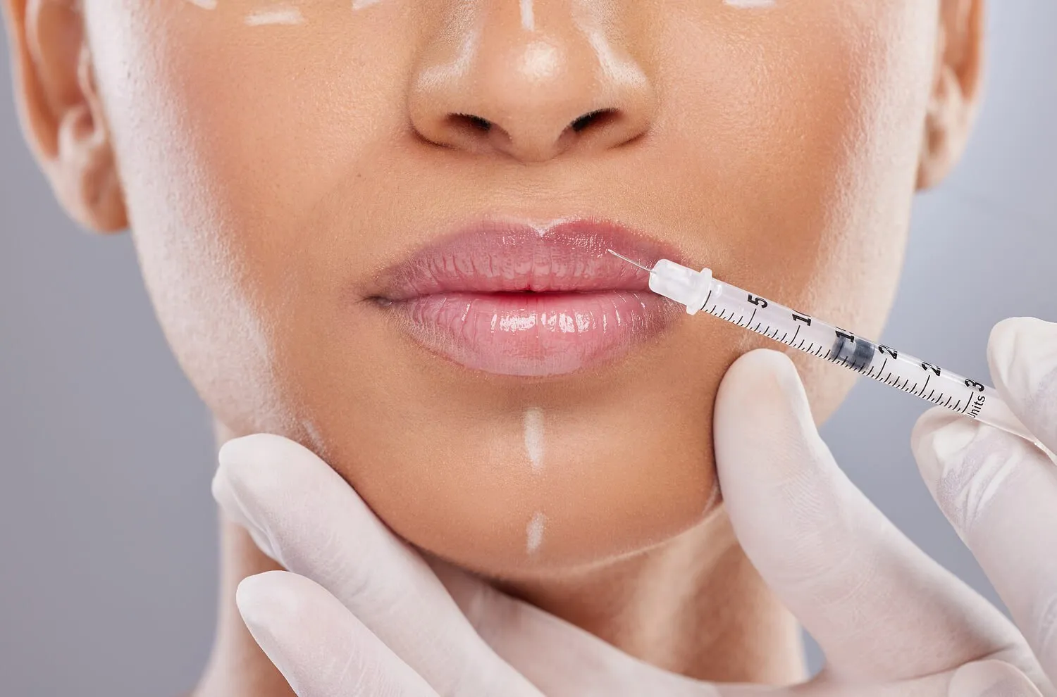 Lip Fillers Gone Wrong? Here’s How to Prevent and Correct Filler