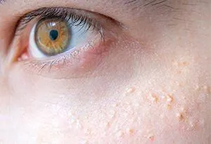 Milia causes and the ways to treat them