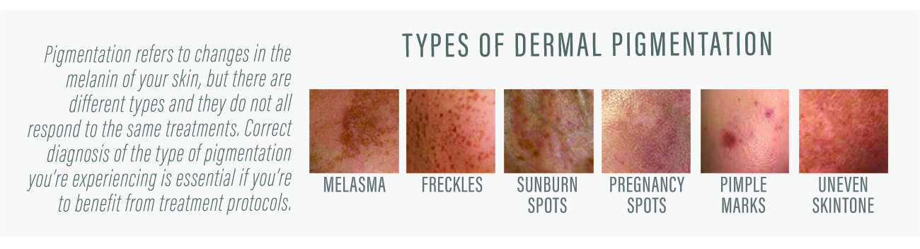 types-of-pigmentation-for-blog Skin Deep: Everything you need to know about Pigmentation content post image