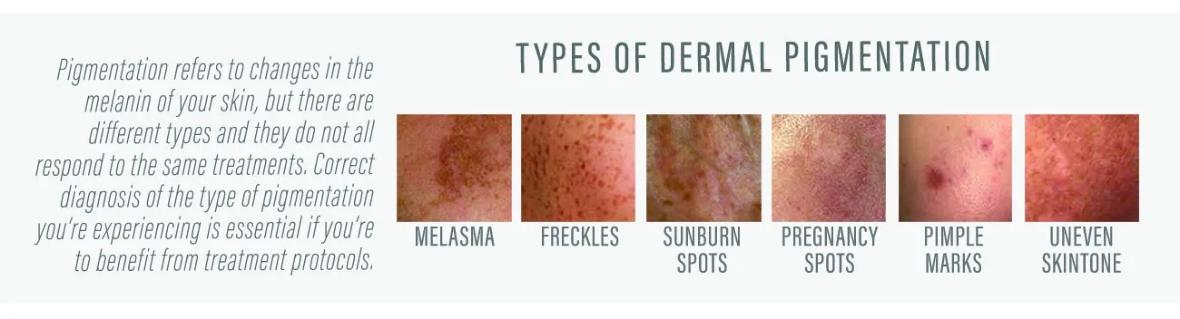 Skin Deep: Everything you need to know about Pigmentation content post image