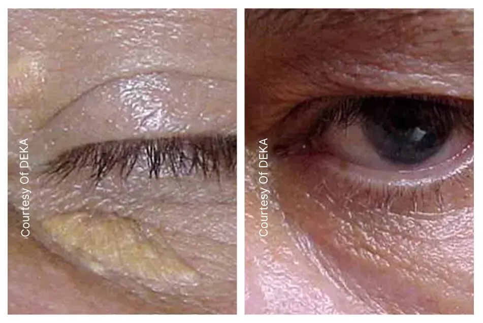 Effective treatments for xanthelasma (deposits around the eyes) content post image