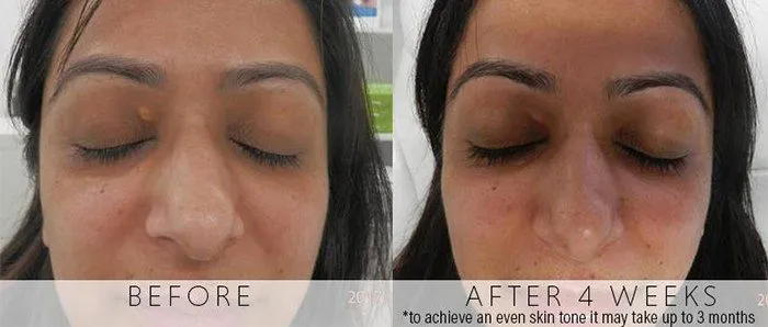 xanthelasma-befor-after