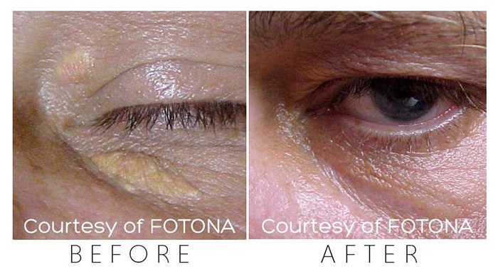 xanthelasma deka xanthelasma deka